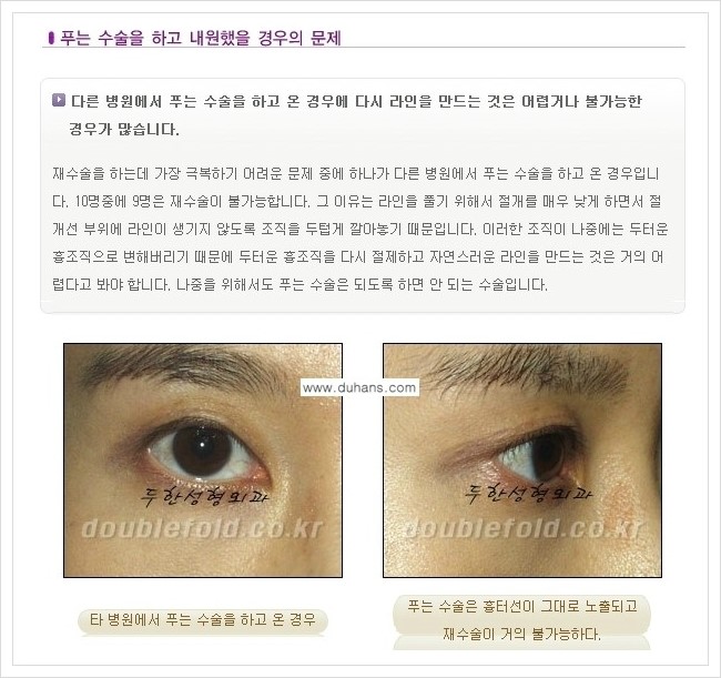 [두한성형외과 경쟁력 쌍꺼풀 재수술(극한 재수술)] - [쌍꺼풀 재수술에서 극복해야 할 여러 가지 상황과 문제점들 안내] 관련 이미지 10