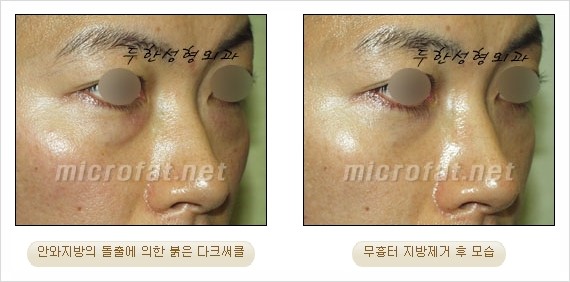 [두한성형외과 쌍커풀수술] - [눈성형 방법에 대한 자주하는 질문과 답변] 관련 이미지 165