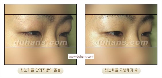 ⁠⁠[두한성형외과 경쟁력 안검성형] - [젊은 눈매를 위한 윗눈꺼풀 지방제거, 눈밑 지방제거] 관련 이미지 10