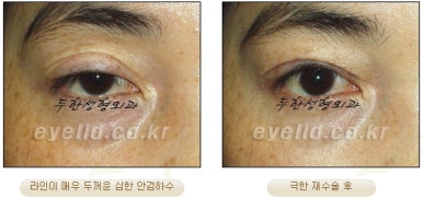 Duhan Plastic Surgery Ophthalmic Reoperation - What Is a Successful Double Eyelid Revision Surgery? image 17