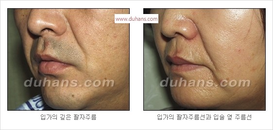 [두한성형외과 경쟁력 주름성형] - [입가주름과 코옆 팔자주름제거 지방이식 시술의 효과] 관련 이미지 4