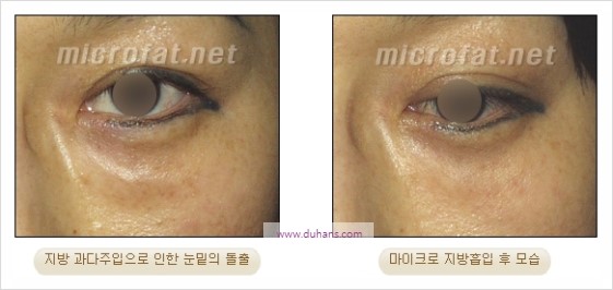 [두한성형외과 경쟁력 지방이식] - [두한 자가지방이식 클리닉 안내]​ 관련 이미지 87