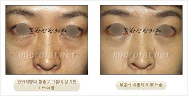 두한성형외과 눈밑수술 - 다크서클 수술 전후 관리 안내 관련 이미지 41