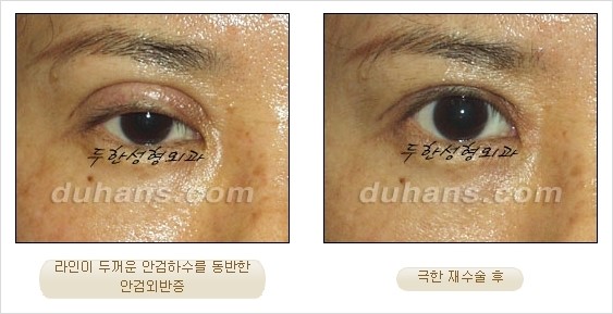 [두한성형외과 경쟁력 쌍꺼풀 재수술 리더 ] - [쌍꺼풀 재수술 과정, 쌍꺼풀 재수술 실패의 원인, 극한 재수술] 관련 이미지 11