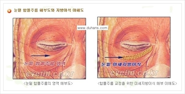 [두한성형외과 경쟁력 눈밑성형] - [다크써클 수술 안내 2.] 관련 이미지 4