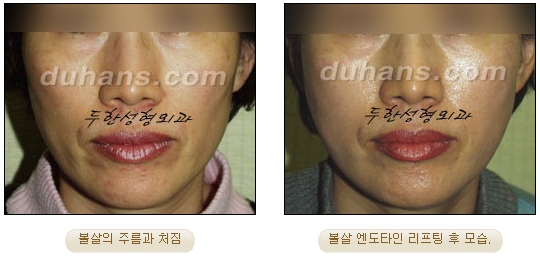 [Duhan Plastic Surgery Wrinkle Removal] - [Wrinkle Removal Treatment Methods] image 29