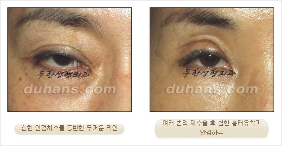 [두한성형외과 경쟁력 쌍꺼풀 재수술 리더 ] - [쌍꺼풀 재수술 과정, 쌍꺼풀 재수술 실패의 원인, 극한 재수술] 관련 이미지 2