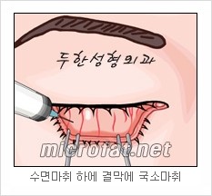 두한성형외과 눈밑성형 - 눈밑지방제거, 눈밑주름, 눈밑지방재배치 관련 이미지 4