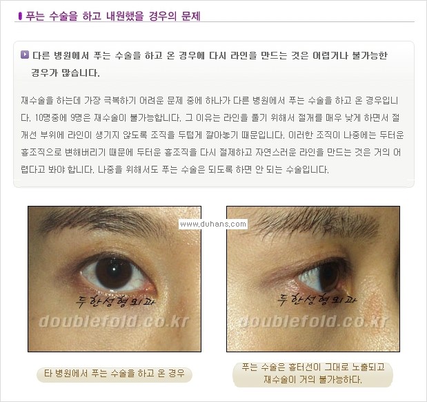 [두한성형외과 경쟁력 쌍꺼풀 재수술, 극한 재수술] - [쌍꺼풀 재수술, 극한 재수술 시 문제점 안내] 관련 이미지 10