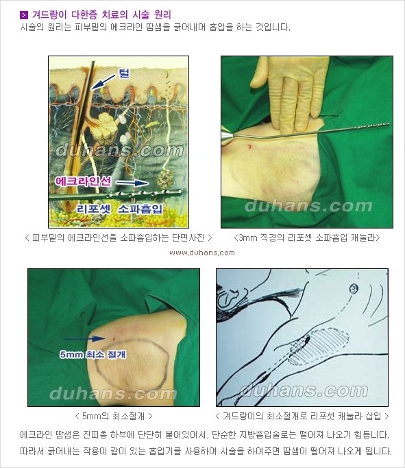 [두한성형외과 경쟁력 액취증 다한증 치료] - [겨드랑이 다한증 치료 방법] 관련 이미지 2