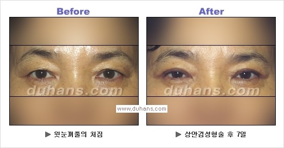 [두한성형외과 경쟁력 눈성형] - [상큼하고 환한 눈매! 상안검 성형(윗눈꺼풀 처짐) 안내] 관련 이미지 10