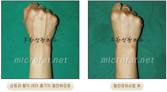 [Duhan Plastic Surgery Clinic Varicose Veins] - [Hand and Arm Venous Dilation] image 6