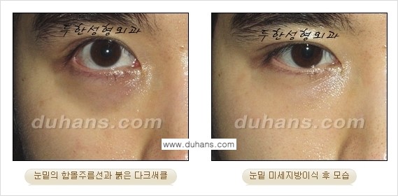 [두한성형외과 상큼하고 환한 눈매완성] - [눈밑 미세지방이식 ②] 관련 이미지 16