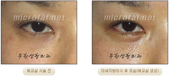 Duhan Plastic Surgery Under-Eye Surgery - Correction with Fat Grafting After Aegyo-Sal Filler image 29