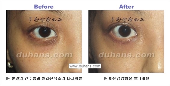[두한성형외과의 상큼하고 환한 젊은 눈매완성] - [하안검 성형술 ②] 관련 이미지 7