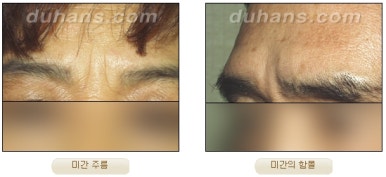 [Duhan Plastic Surgery Wrinkle Improvement] - [Wrinkle Lifting] image 4