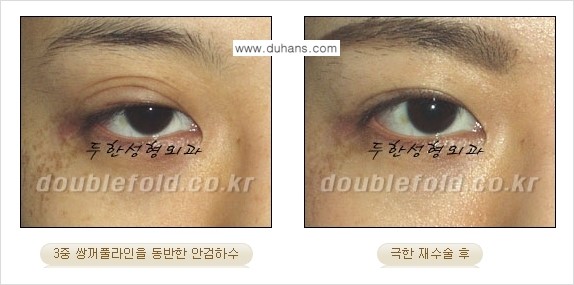 [두한성형외과 경쟁력 눈성형] - [재수술시 유의해야 할 사항과 성공 요건] 관련 이미지 11