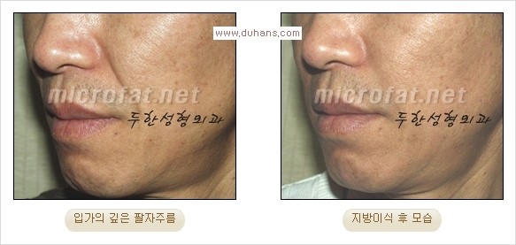 [두한성형외과 경쟁력 주름성형] - [입가주름과 코옆 팔자주름제거 지방이식 시술의 효과] 관련 이미지 15