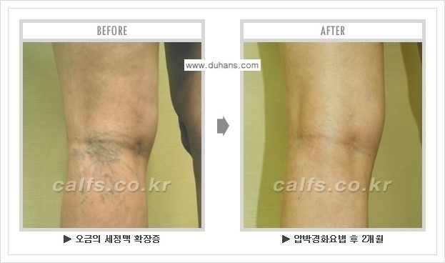 [두한성형외과 경쟁력 멀티종아리성형] - [하지정맥류 치료 안내] 관련 이미지 10
