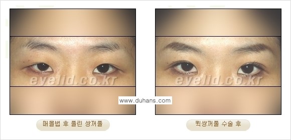 ​[두한성형외과 경쟁력 눈성형] - [자연스러운면서 매력적인 쌍꺼풀 퀵 쌍꺼풀 수술 안내] 관련 이미지 25