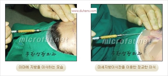 [두한성형외과 경쟁력 동안성형 리더] - ​[미간주름, 이마주름, 안검성형, 이마거상술, 눈썹거상술] 관련 이미지 30