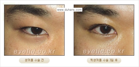 [두한성형외과 성형 FOCUS] - [퀵쌍꺼풀 수술 ③] 관련 이미지 3