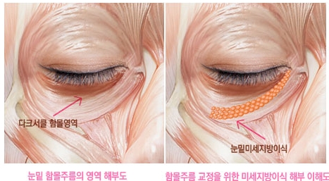 [두한성형외과 다크서클] - [콜펫지방이식] 관련 이미지 17