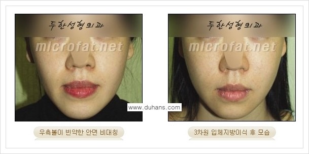 [두한성형외과 경쟁력 윤곽성형] - [볼, 볼살 지방이식] 관련 이미지 26