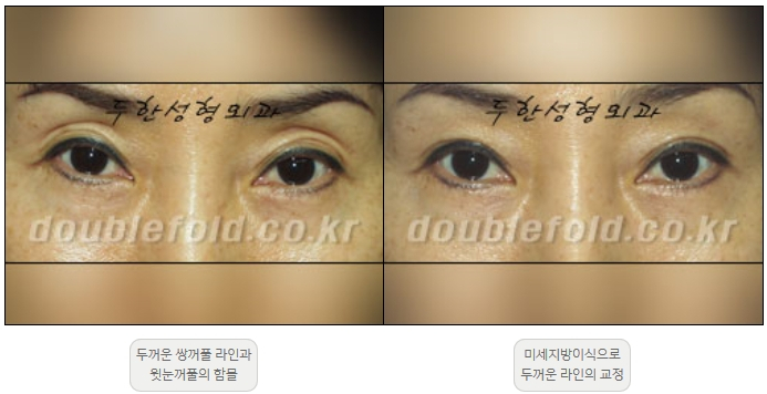 [Duhan Plastic Surgery Double Eyelid Revision] - [Thick Double Eyelid Line] image 21