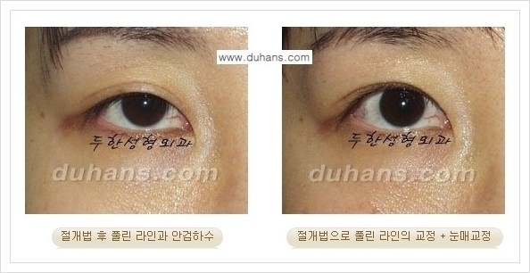 [두한성형외과 경쟁력 쌍꺼풀 재수술, 극한 재수술] - [풀려버린 쌍꺼풀 라인의 교정 방법 안내] 관련 이미지 5