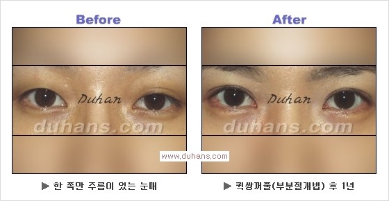 ​[두한성형외과 경쟁력 눈성형] - [자연스러운면서 매력적인 쌍꺼풀 퀵 쌍꺼풀 수술 안내] 관련 이미지 14