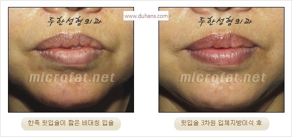 ​​[두한성형외과 경쟁력 미세지방이식] - [볼륨감 있는 입술성형] 관련 이미지 9