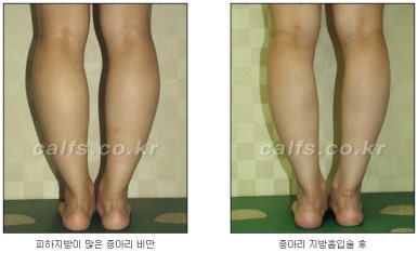 [두한성형외과 종아리수술] - [종아리성형 실패의 원인] 관련 이미지 6