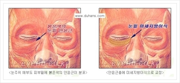 [두한성형외과 경쟁력 눈밑성형] - [다크써클 수술 안내 1.] 관련 이미지 4