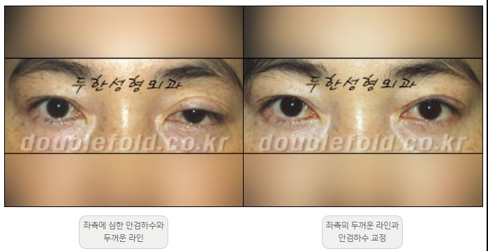 [두한성형외과 쌍커플재수술] - [비대칭 쌍커풀 라인] 관련 이미지 10