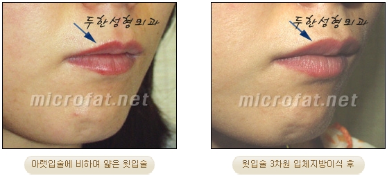 [Duhan Plastic Surgery Lip Surgery] - [Lip Correction Fat Grafting] image 17