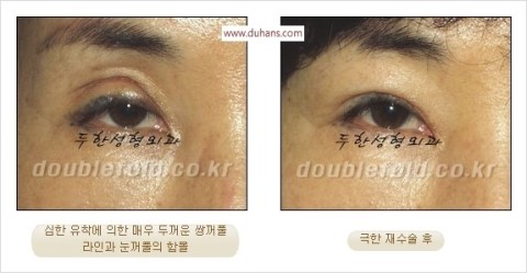 ​[두한성형외과 눈재수술] - [앞트임복원, 뒤트임복원, 쌍꺼풀복원] 관련 이미지 19