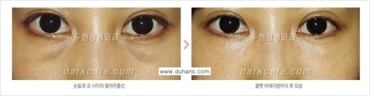 [두한성형외과 경쟁력 다크써클 교정] - [눈밑 사선의 함몰주름선이 진하게 있는 다크써클 증상 치료 안내] 관련 이미지 3