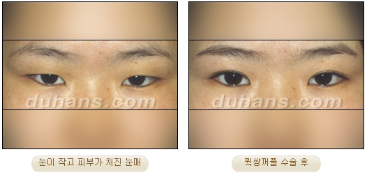 [Duhan Plastic Surgery Double Eyelid Surgery] - [Types of Double Eyelid Surgery] image 24