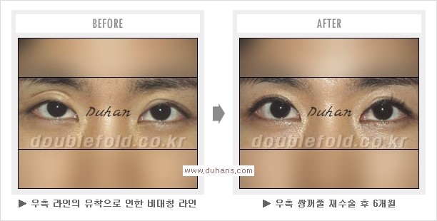 ​[두한성형외과 경쟁력 쌍꺼풀 재수술] - [아름다운 쌍꺼풀 선의 기준과 쌍꺼풀 재수술시 검사와 테스트 안내] 관련 이미지 12
