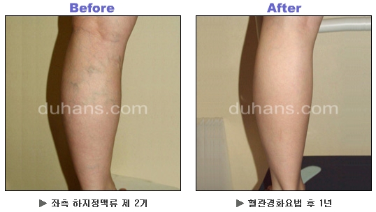 [두한성형외과 정맥류] - [하지정맥류, 정맥확장증, 혈관확장증] 관련 이미지 23