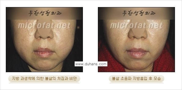 ​[두한성형외과 가을엔 지방흡입을] - [볼살, 눈밑, 턱선 초음파 미세지방흡입] 관련 이미지 4