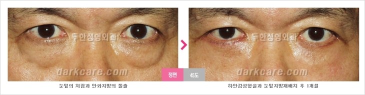 ​[두한성형외과 경쟁력 눈밑성형 리더] - [눈밑 다크써클의 증상, 원인, 종류, 치료방법 안내] 관련 이미지 67