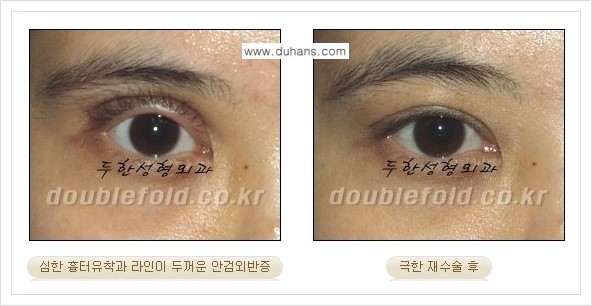 [두한성형외과 경쟁력 쌍꺼풀 재수술, 극한 재수술] - [망친 눈(쌍꺼풀) 복원수술과 일반 쌍꺼풀 재수술과의 차이점] 관련 이미지 12