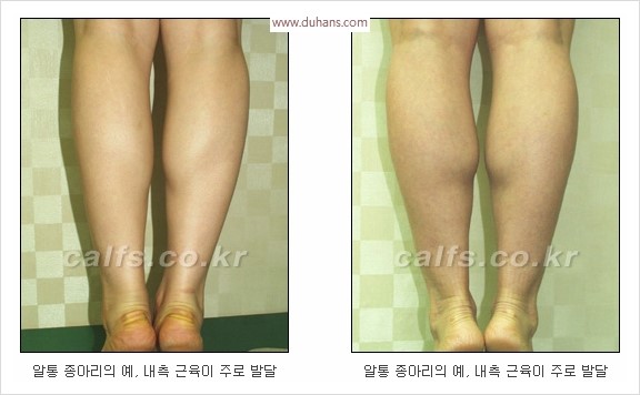 [두한성형외과 경쟁력 종아리성형 리더] - [종아리성형 실패의 원인과 원인에 따른 적합한 시술 방법] 관련 이미지 1