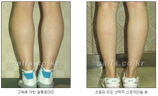 ​[두한성형외과 종아리성형] - [나에게 맞는 종아리시술] 관련 이미지 10