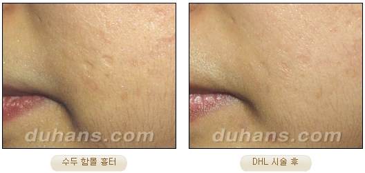 [DuHan Plastic Surgery Scar] - [DHL Simple Scar Treatment] image 9