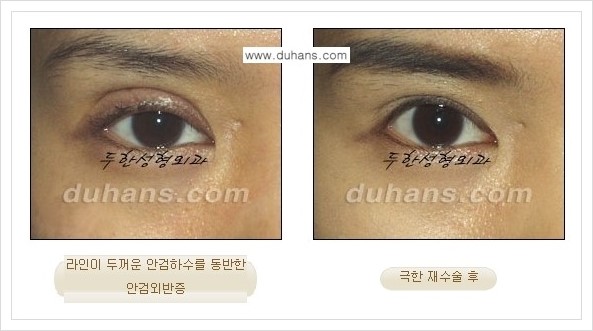 [두한성형외과 경쟁력 망가진 눈 복원수술] - [두꺼운 라인을 교정하는 극한 재수술(Extreme Reoperation) 안내] 관련 이미지 7