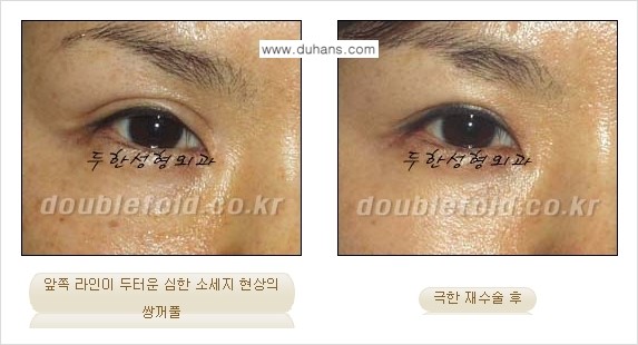 [두한성형외과 NO.1 "극한 눈 재수술"] - [극한 눈 재수술 성공사례 ①] 관련 이미지 3