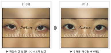 두한성형외과 쌍커풀 재수술 - 짝눈 눈매교정, 가성 안검하수 교정과 뒤밑트임 관련 이미지 47